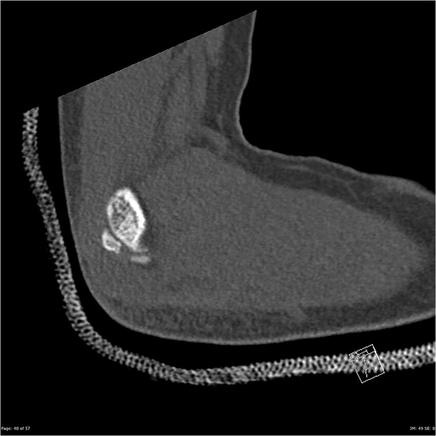 Capitellum fracture (Radiopaedia 23352-23426 Sagittal bone window 48).jpg
