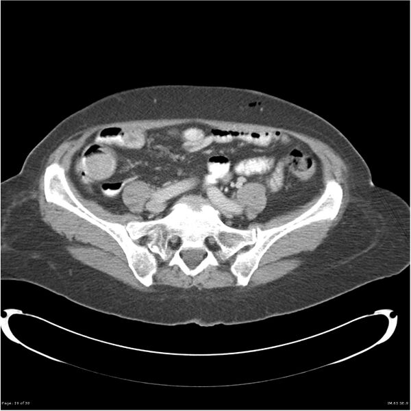 File:Carcinoid tumor of the ileum with metastasis to orbit (Radiopaedia 28165-28425 A 19).jpg