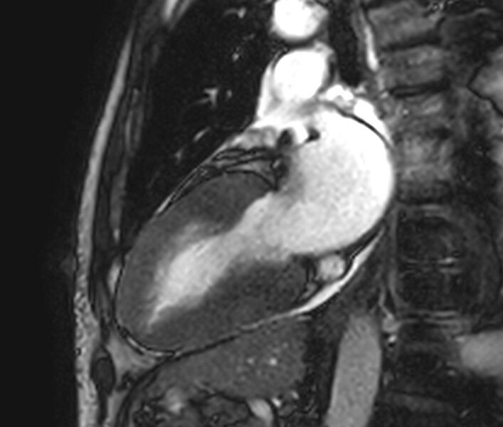 File:Cardiac amyloidosis (Radiopaedia 39736-42124 B 15).jpg