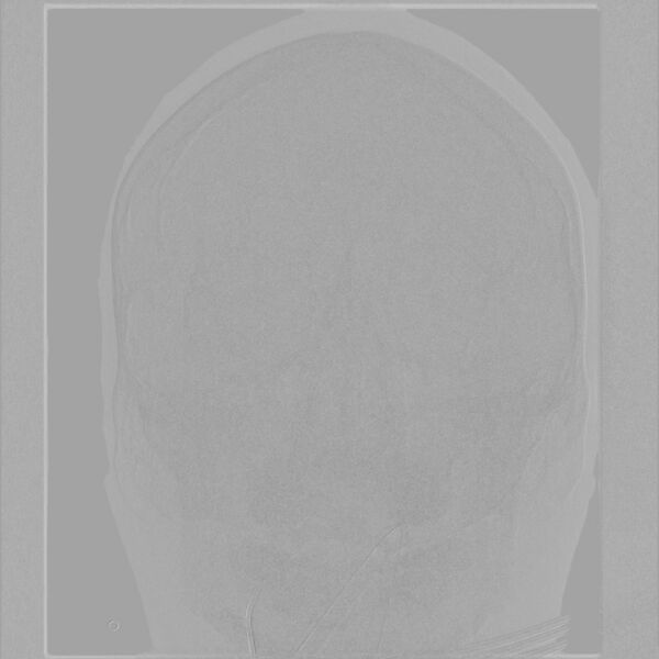 File:Caroticocavernous fistula - direct (Radiopaedia 61660-69666 A 3).jpg