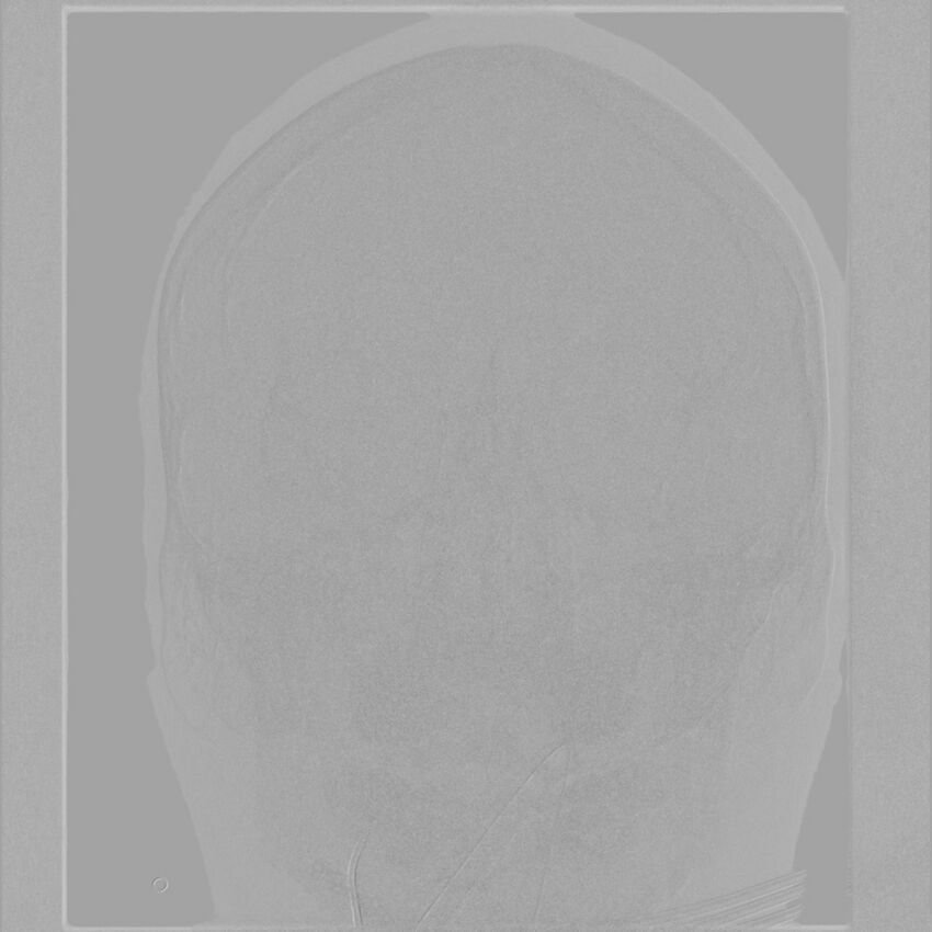 Caroticocavernous fistula - direct (Radiopaedia 61660-69666 A 3).jpg