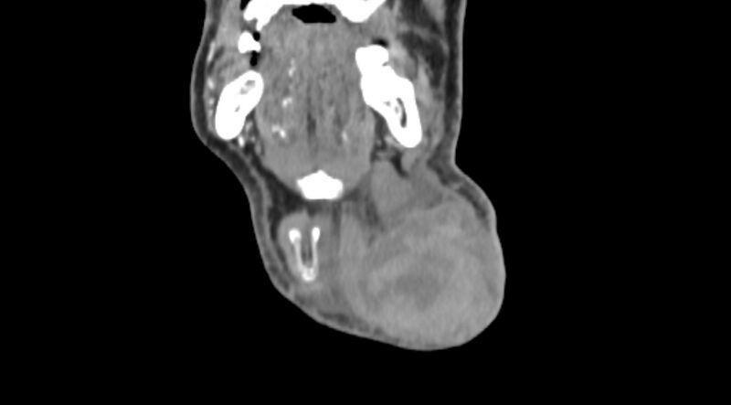 File:Carotid artery pseudoaneurysm (Radiopaedia 84030-99259 D 10).jpg