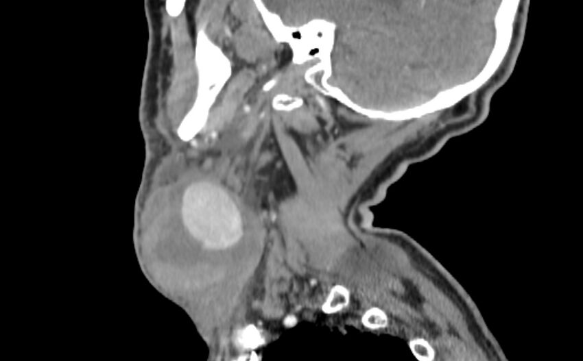 Carotid artery pseudoaneurysm (Radiopaedia 84030-99259 E 40).jpg