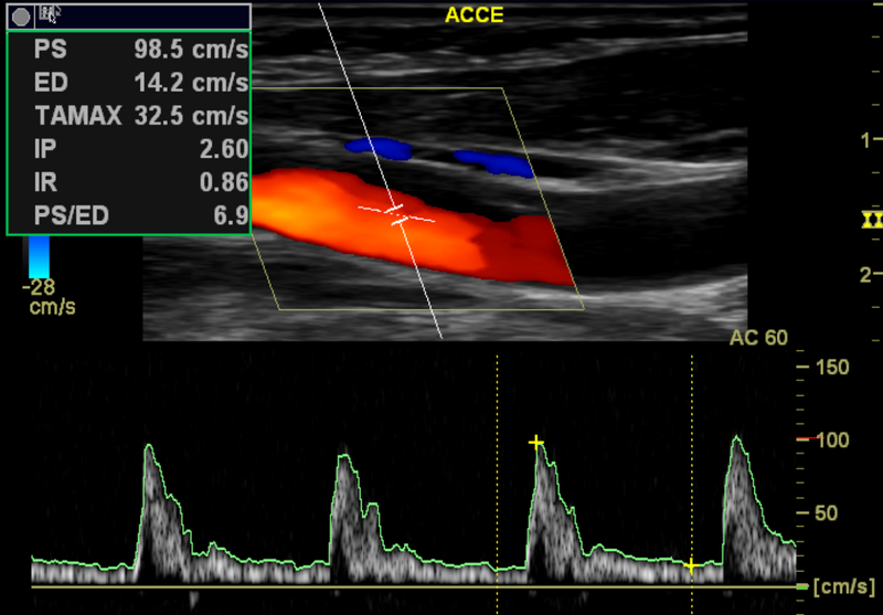 File:Carotid artery stenosis (Radiopaedia 28786-29088 J 1).png