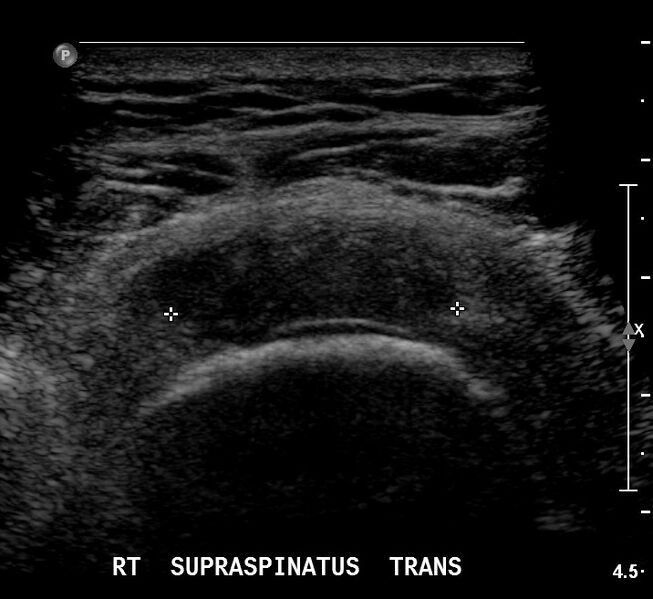 File:Cartilage interface sign - supraspinatus tear (Radiopaedia 14198-14054 A 1).jpg