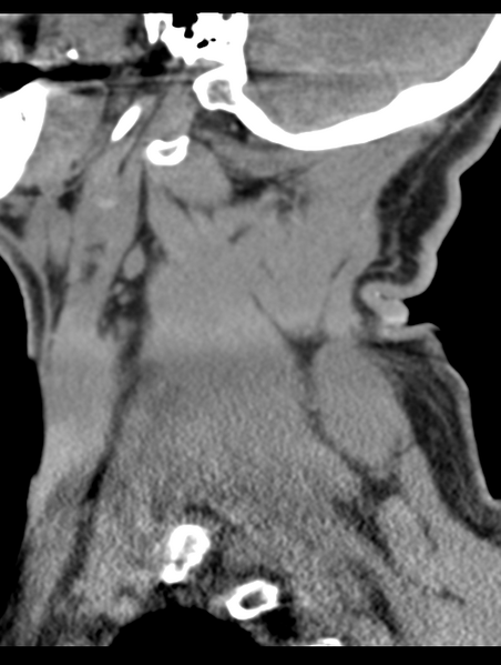 File:Cavernoma of cervical cord (Radiopaedia 50838-56346 B 15).png