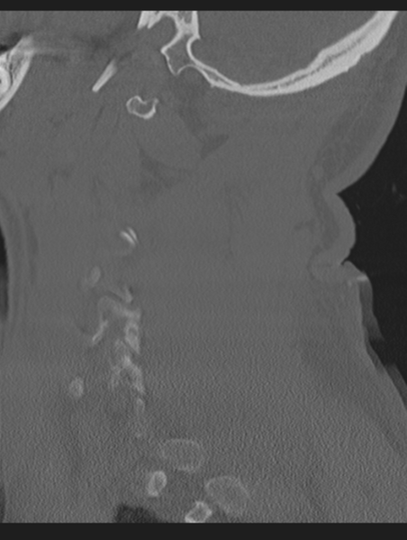 File:Cavernoma of cervical cord (Radiopaedia 50838-56346 Sagittal bone window 63).png