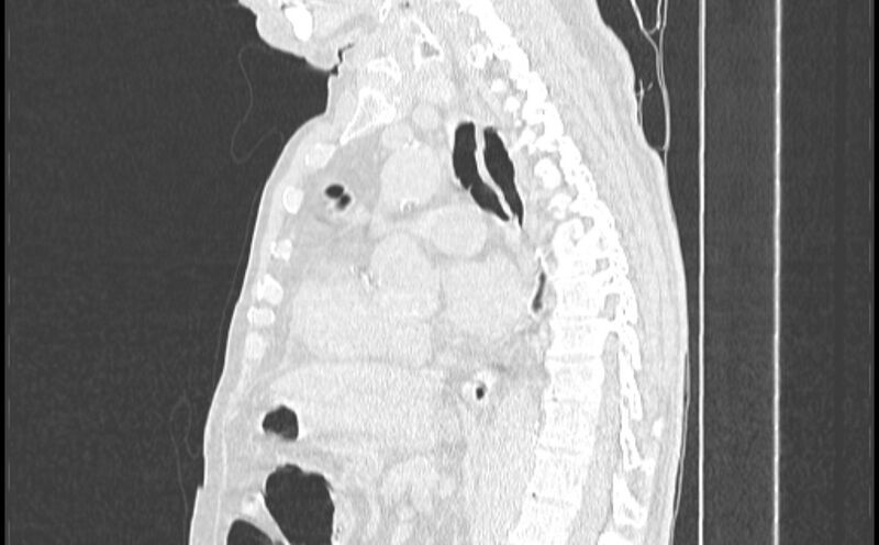 File:Cavitating bronchogenic carcinoma (Radiopaedia 44489-48162 Sagittal lung window 29).jpg