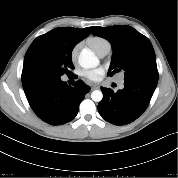 File:Cavitating lung cancer (Radiopaedia 25796-25945 C+ arterial phase 30).jpg
