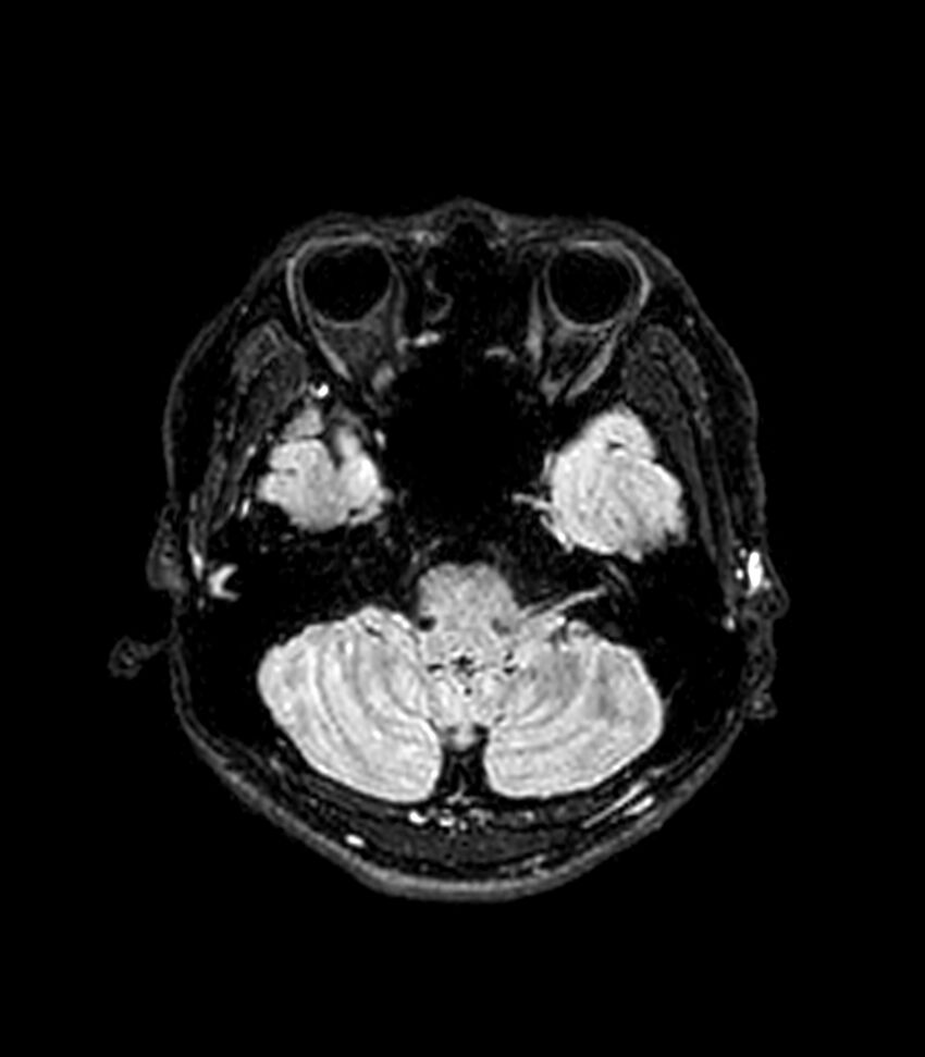 Central neurocytoma (Radiopaedia 79320-92380 Axial FLAIR 235).jpg