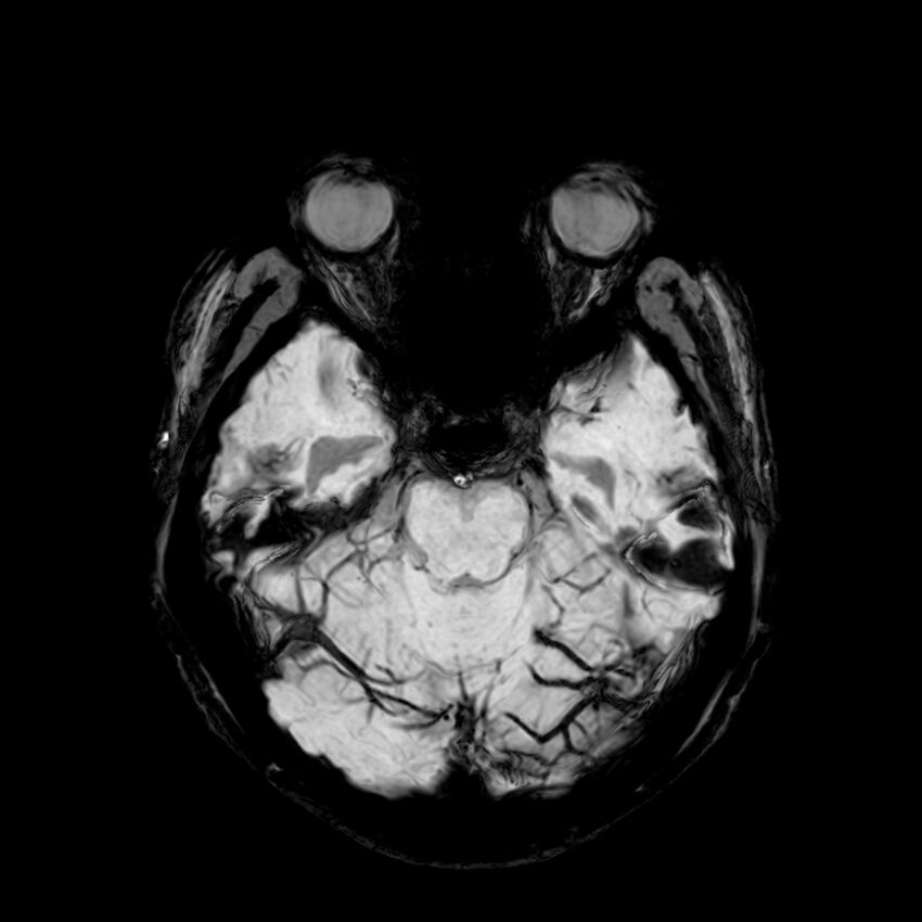 Central neurocytoma (Radiopaedia 79320-92380 Axial SWI 43).jpg