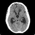 Cerebellar abscess secondary to mastoiditis (Radiopaedia 26284-26412 Axial non-contrast 66).jpg