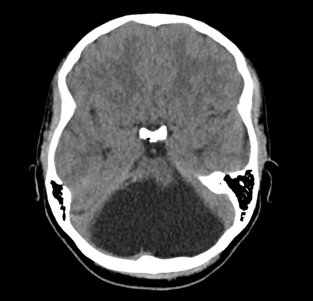 File:Cerebellar agenesis (Radiopaedia 30203-30817 Axial non-contrast 14).jpg
