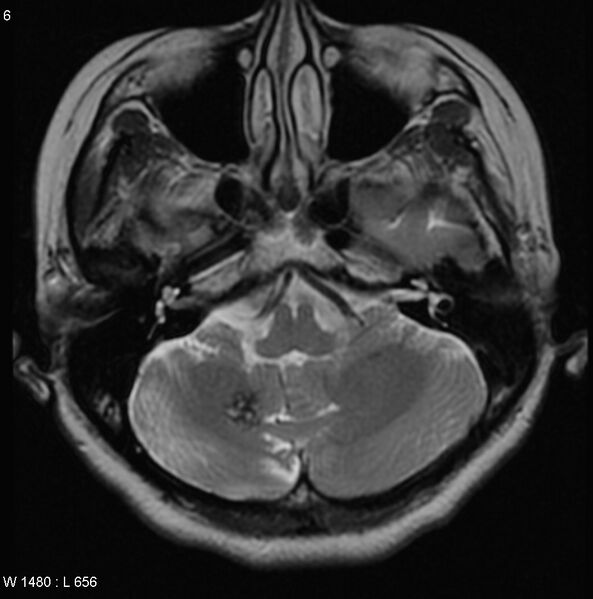 File:Cerebellar arteriovenous malformation (Radiopaedia 5220-6988 Axial T2 2).jpg