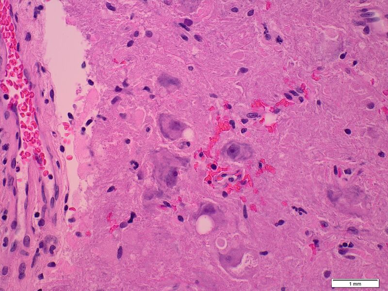 File:Cerebellar gangliocytoma (Radiopaedia 65377-74423 H&E 1).jpg
