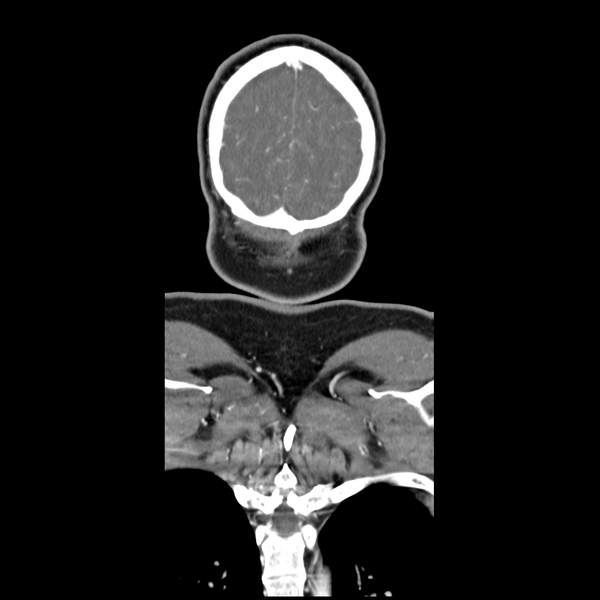 File:Cerebellar infarct due to vertebral artery dissection with posterior fossa decompression (Radiopaedia 82779-97029 D 59).png
