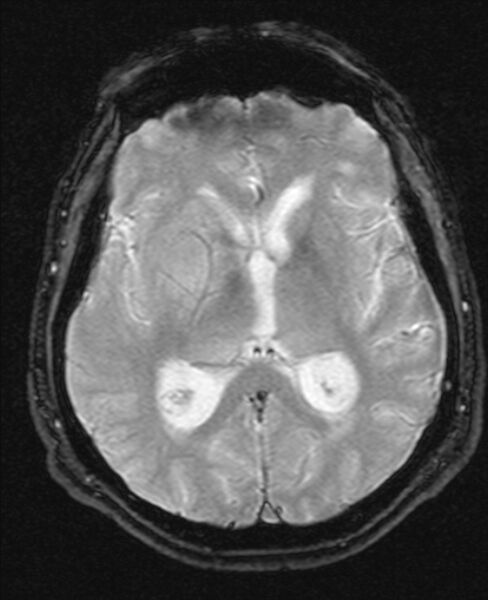 File:Cerebellopontine angle meningioma (Radiopaedia 24459-24764 Axial Gradient Echo 12).jpg
