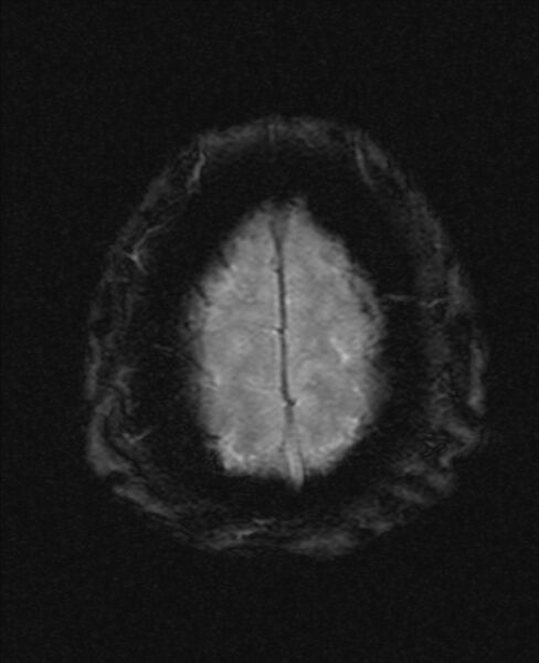 File:Cerebellopontine angle meningioma (Radiopaedia 24459-24764 Axial Gradient Echo 22).jpg
