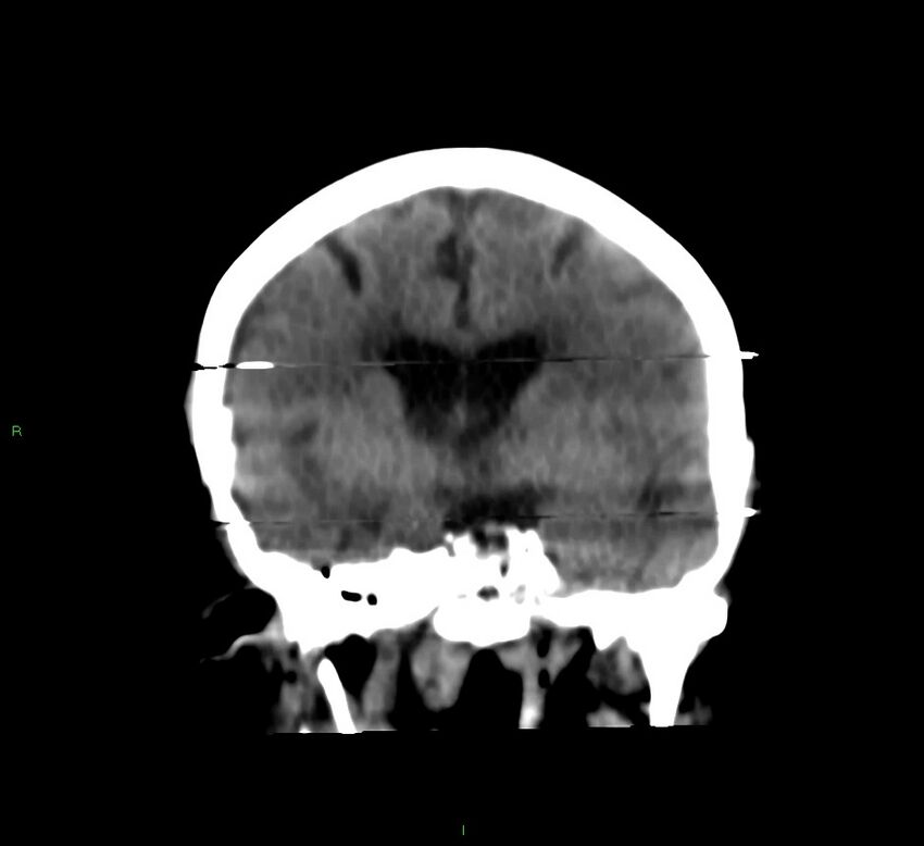 Cerebral amyloid angiopathy-associated lobar intracerebral hemorrhage (Radiopaedia 58377-65514 Coronal non-contrast 37).jpg