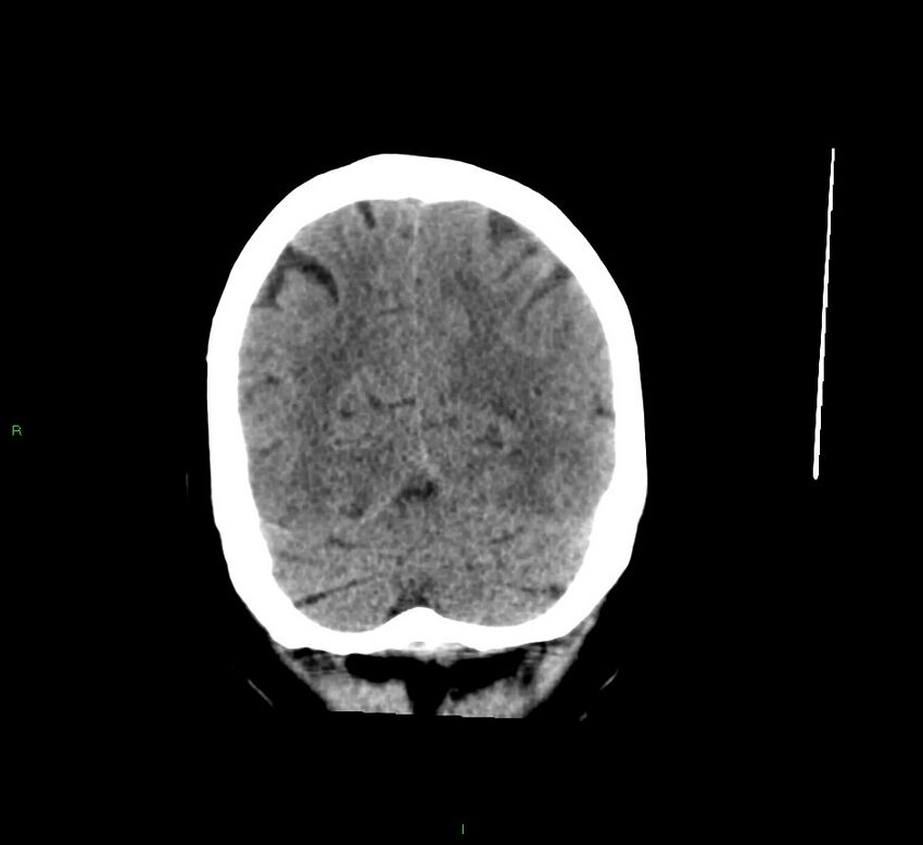 Cerebral amyloid angiopathy-associated lobar intracerebral hemorrhage (Radiopaedia 58529-65681 Coronal non-contrast 16).jpg