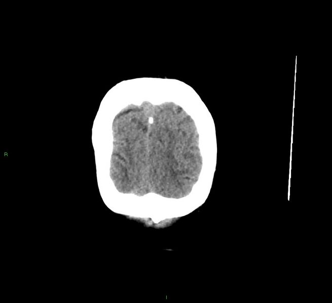 File:Cerebral amyloid angiopathy-associated lobar intracerebral hemorrhage (Radiopaedia 58529-65681 Coronal non-contrast 9).jpg