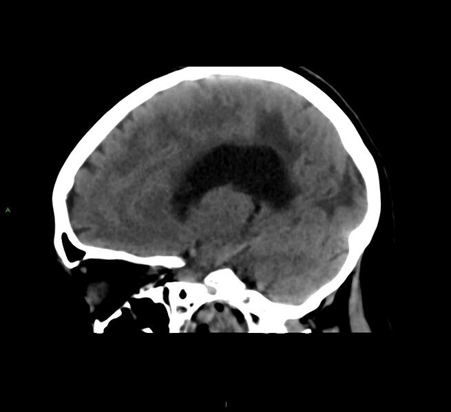 File:Cerebral amyloid angiopathy-associated lobar intracerebral hemorrhage (Radiopaedia 58561-65724 C 20).jpg