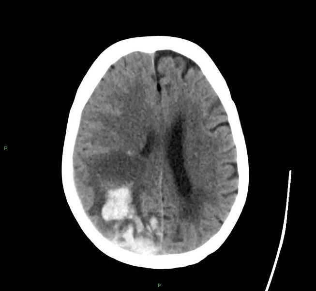 File:Cerebral amyloid angiopathy-associated lobar intracerebral hemorrhage (Radiopaedia 58563-65727 Axial non-contrast 22).jpg