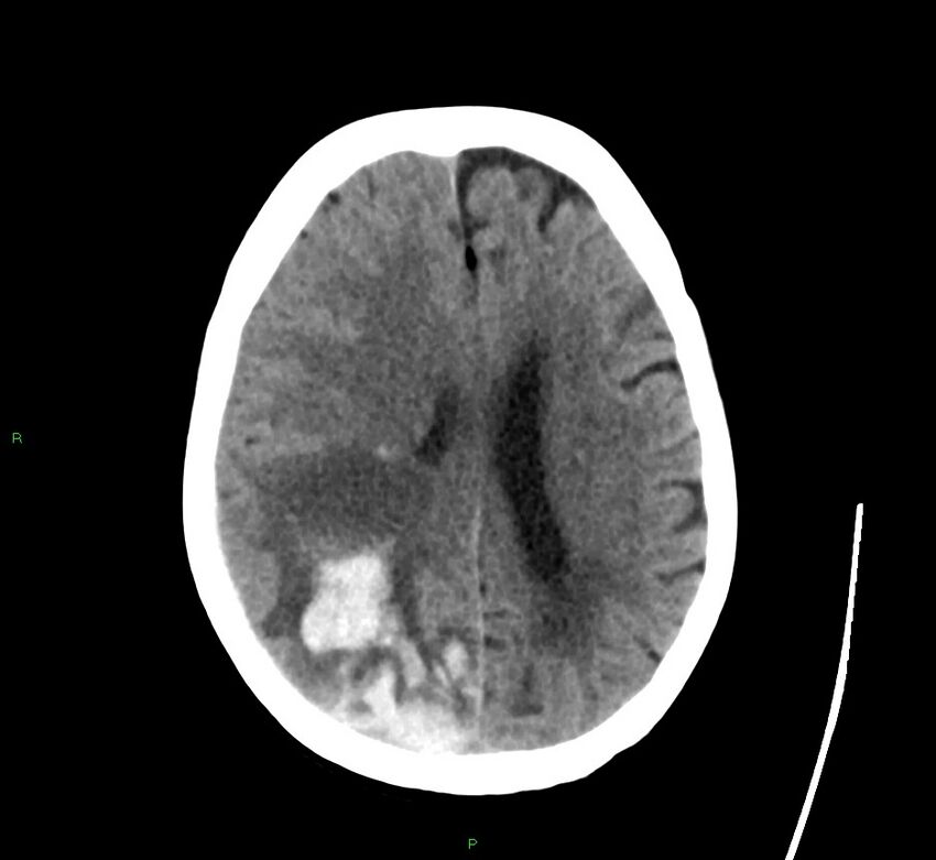 Cerebral amyloid angiopathy-associated lobar intracerebral hemorrhage (Radiopaedia 58563-65727 Axial non-contrast 22).jpg
