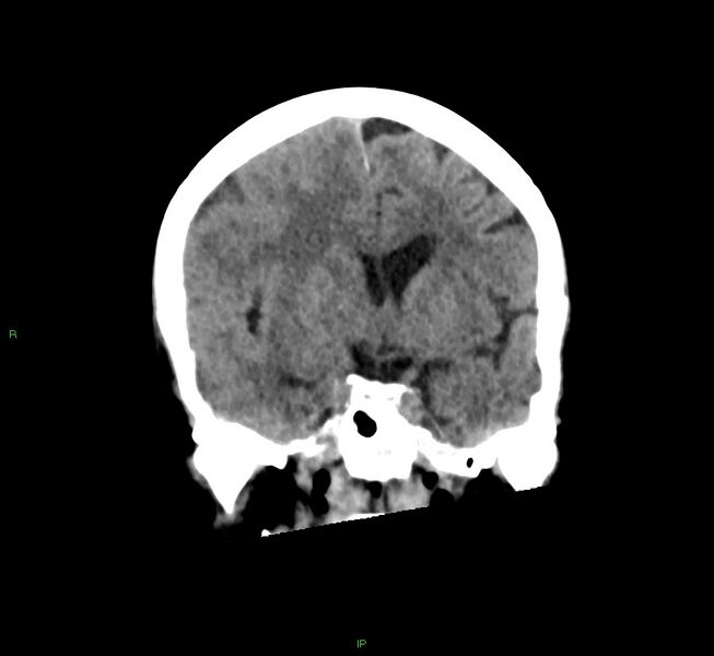 File:Cerebral amyloid angiopathy-associated lobar intracerebral hemorrhage (Radiopaedia 58563-65727 Coronal non-contrast 40).jpg