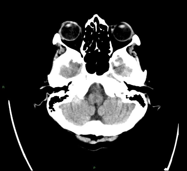 File:Cerebral amyloid angiopathy-associated lobar intracerebral hemorrhage (Radiopaedia 58566-65731 Axial non-contrast 4).jpg