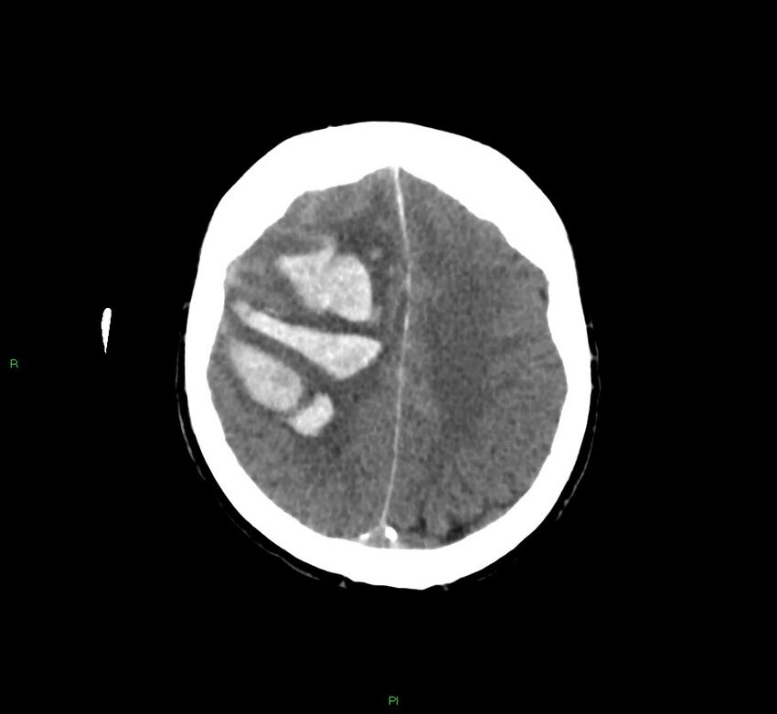 Cerebral amyloid angiopathy-associated lobar intracerebral hemorrhage (Radiopaedia 58756-65977 Axial non-contrast 17).jpg