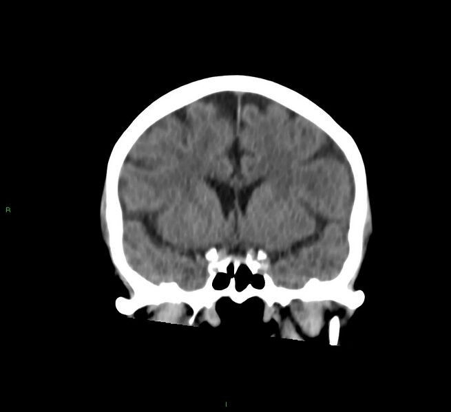 File:Cerebral amyloid angiopathy-associated lobar intracerebral hemorrhage (Radiopaedia 58757-65978 Coronal non-contrast 43).jpg