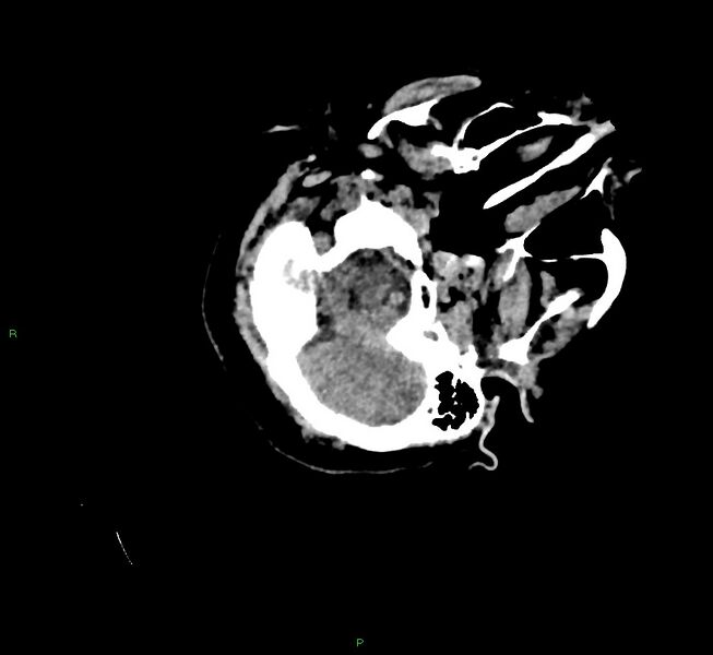 File:Cerebral amyloid angiopathy-associated lobar intracerebral hemorrhage (Radiopaedia 58757-65979 Axial non-contrast 21).jpg