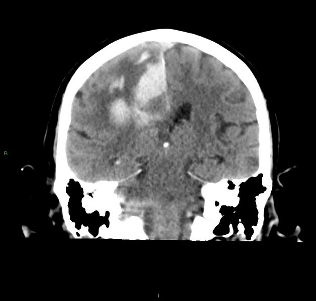 File:Cerebral amyloid angiopathy-associated lobar intracerebral hemorrhage (Radiopaedia 59356-66716 Coronal non-contrast 30).jpg
