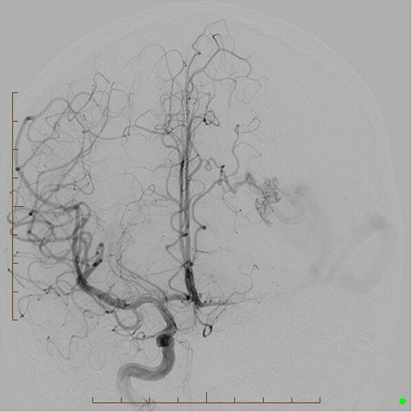 File:Cerebral arteriovenous malformation (AVM) (Radiopaedia 78162-90707 A 10).jpg