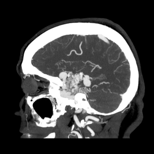 File:Cerebral arteriovenous malformation (Radiopaedia 43729-47189 D 35).jpg