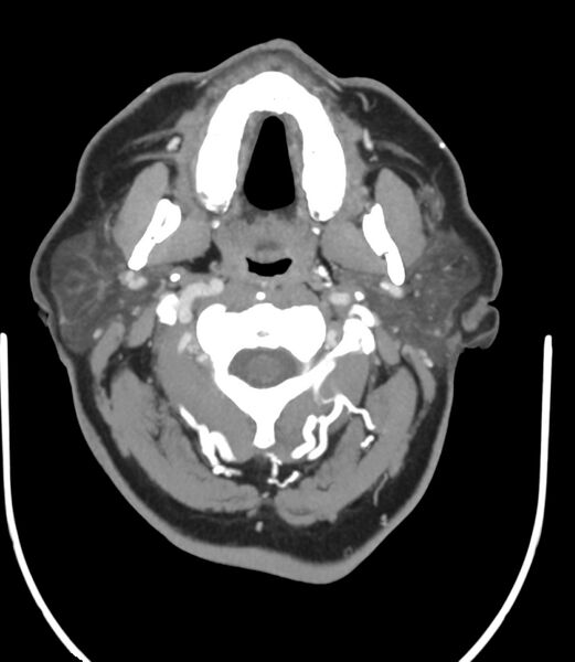 File:Cerebral dural venous sinus thrombosis (Radiopaedia 86514-102576 A 15).jpg