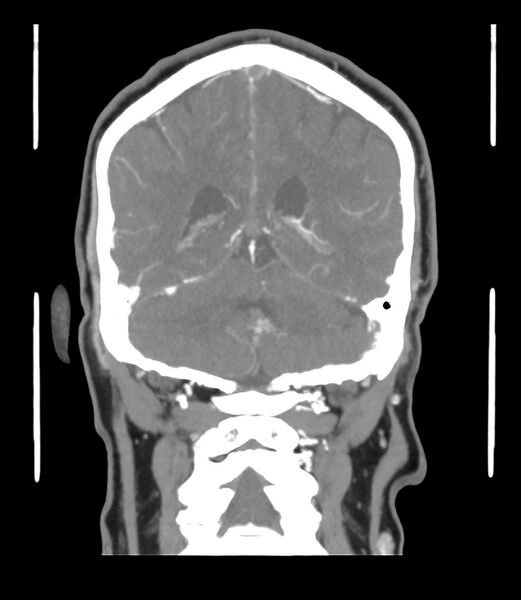 File:Cerebral dural venous sinus thrombosis (Radiopaedia 86514-102576 B 50).jpg