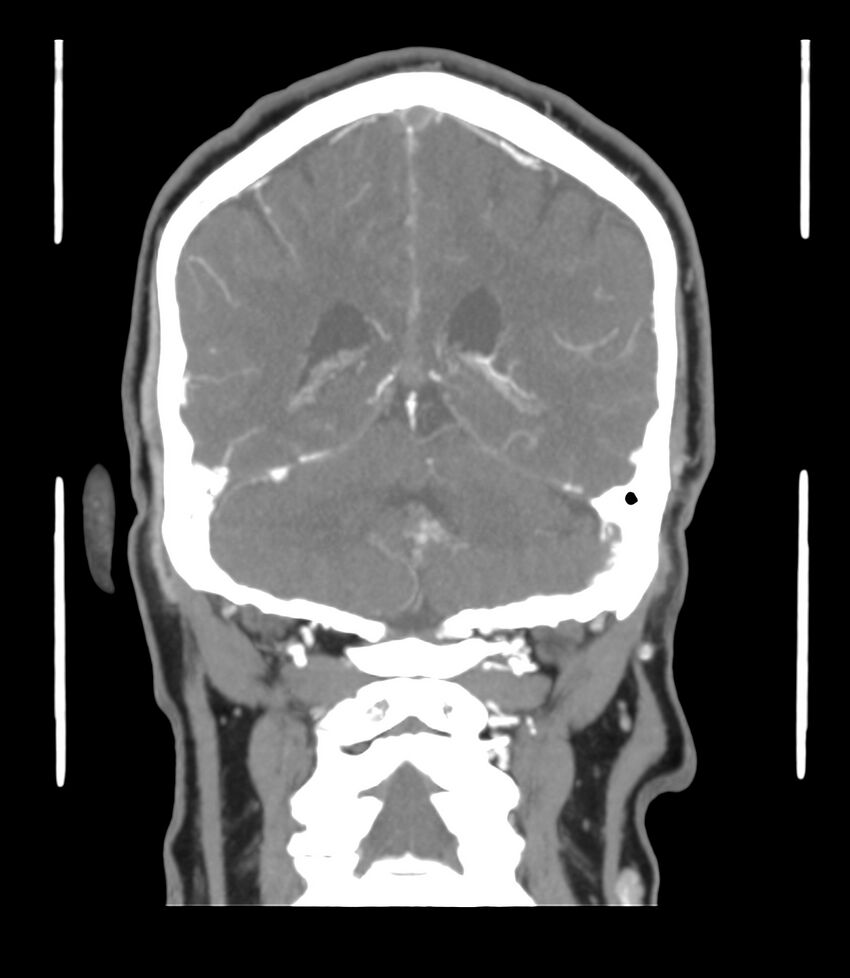 Cerebral dural venous sinus thrombosis (Radiopaedia 86514-102576 B 50).jpg