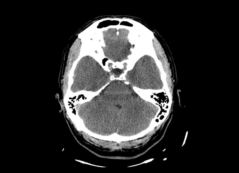 File:Cerebral edema (Radiopaedia 82519-96661 Axial non-contrast 40).jpg
