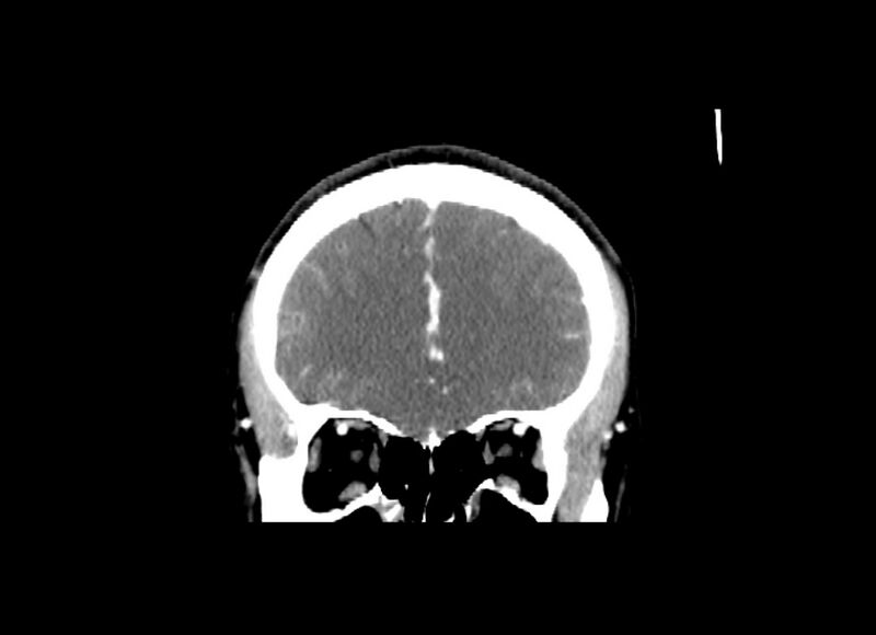 File:Cerebral edema (Radiopaedia 82519-96661 C 47).jpg