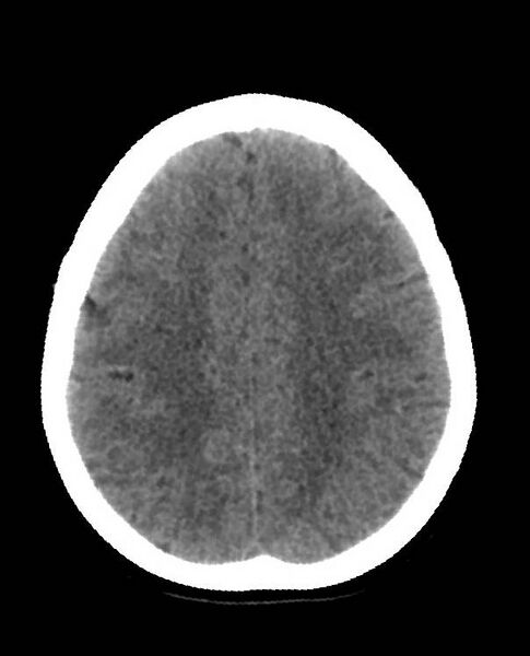 File:Cerebral edema due to severe hyponatremia (Radiopaedia 89826-106938 Axial non-contrast 76).jpg