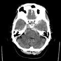 Cerebral hemorrhagic contusions (Radiopaedia 23145-23188 Axial non-contrast 9).jpg