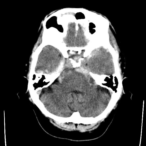 File:Cerebral hemorrhagic contusions (Radiopaedia 23145-23188 Axial non-contrast 9).jpg