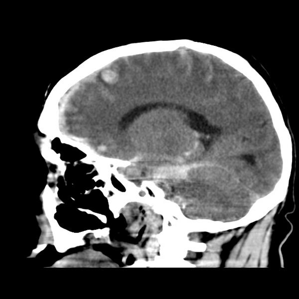 File:Cerebral hemorrhagic contusions (Radiopaedia 23145-23188 C 27).jpg