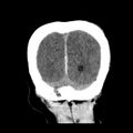 Cerebral hemorrhagic contusions (Radiopaedia 23145-23188 Coronal non-contrast 38).jpg