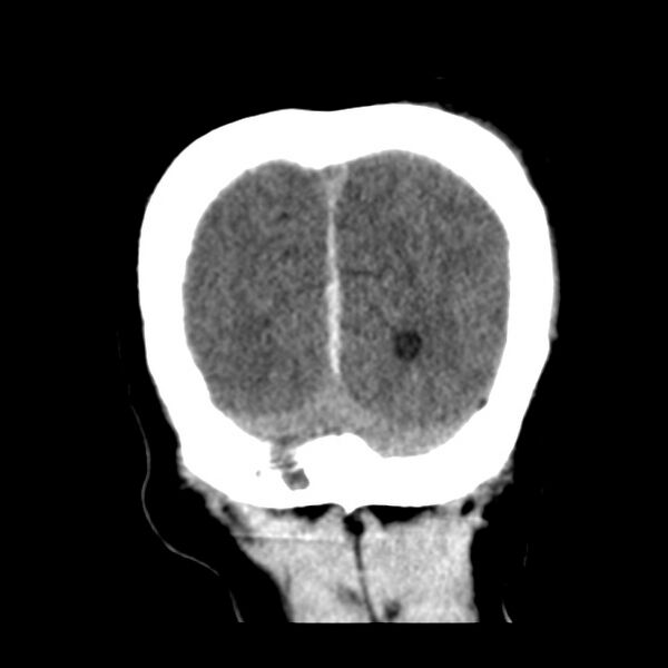 File:Cerebral hemorrhagic contusions (Radiopaedia 23145-23188 Coronal non-contrast 38).jpg