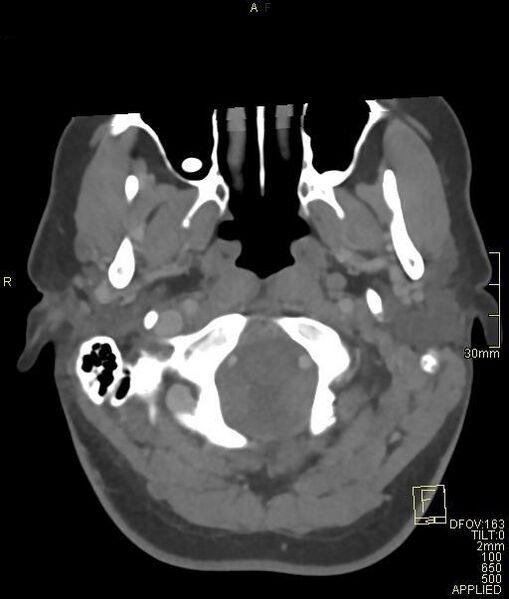 File:Cerebral venous sinus thrombosis (Radiopaedia 91329-108965 Axial venogram 10).jpg