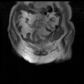 Cervical carcinoma (Radiopaedia 78847-91705 Coronal T1 2).jpg