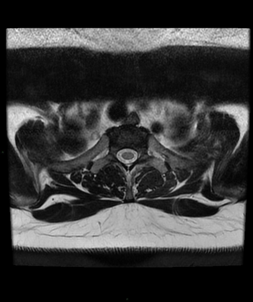 Cervical disc prolapse (Radiopaedia 80258-93598 Axial T2 94).jpg